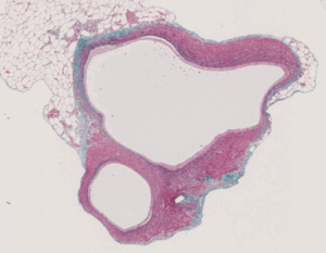 Rethinking Progress in Endometriosis Treatment