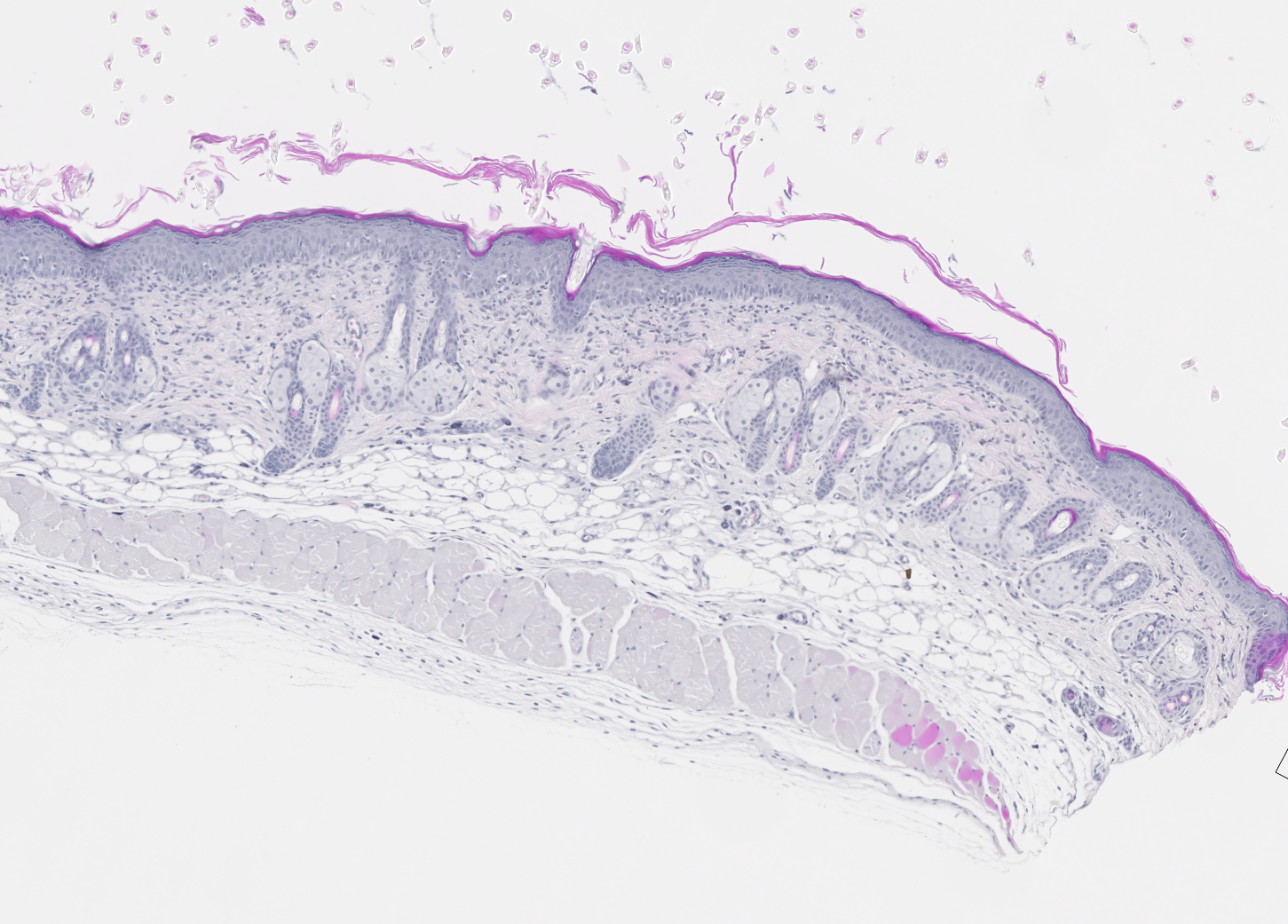 Histological slide of dermal inflammation (H&E stain). Increased dermal and epidermal thickness in skin inflammation.