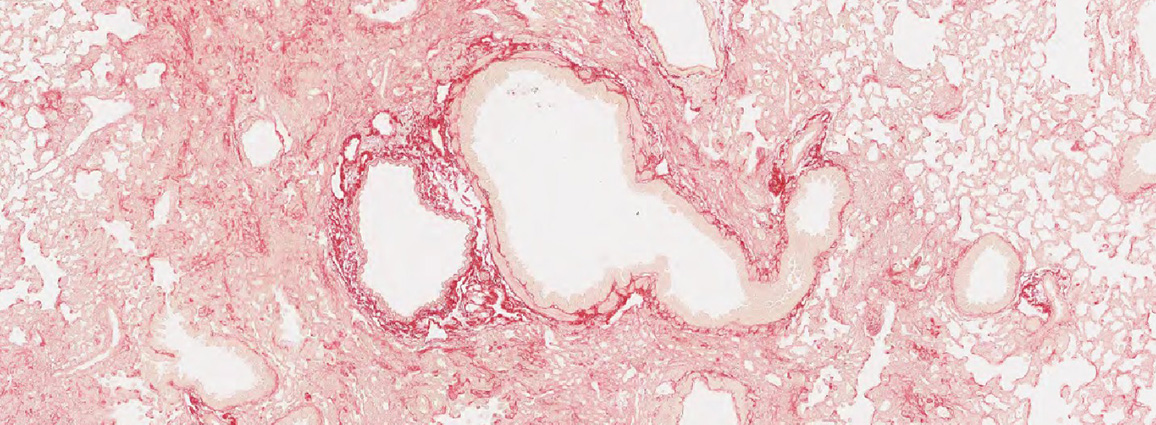 Histology sample from a bleomycin lung fibrosis model with SR stain