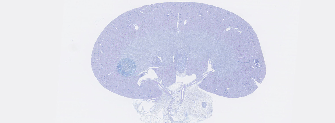 Histology slide of acute kidney injury with H&P stain