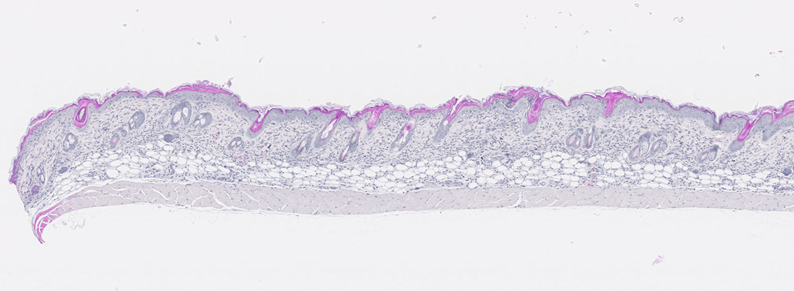 Histology slide of atopic dermatitis