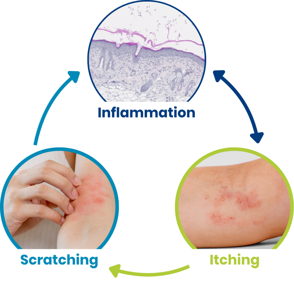Inflammatory Itch Scratch Cycle